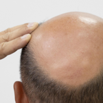 M�nnerkopf von hinten mit Glatze